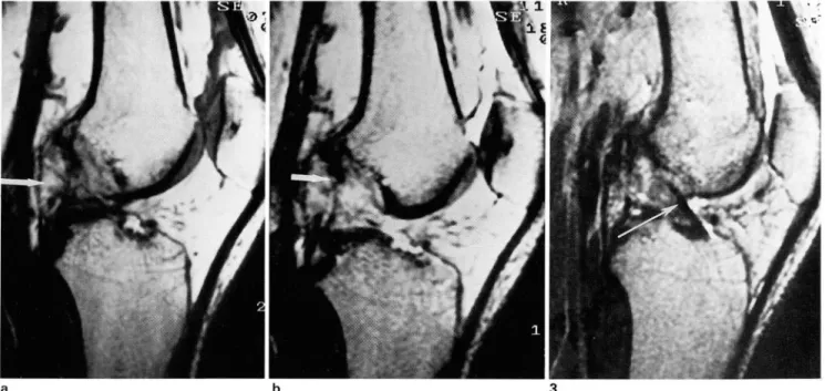 Fig .  2 .  Complete  tear  01  the  ACL  suggesting  old  injury.  T1 -weighted(a)  and  T2 -weighted(b)  sagittal  images  show  an  irregularly  increased signal  intensity at  AC L( arrows)  and  nearly absence  01  bundles  without bulging  contour  0