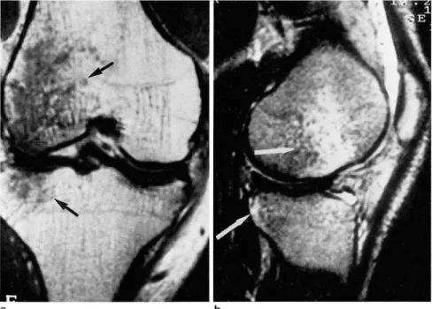 Fig.  5.  ACL tear  with  bone  bruise  a.  T1 - weighted  coronal  image  shows  ir. 