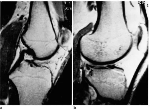 Fig.  7. Associated changes in  ACL  tear ‘  a.  Acute  angulations  of  the  PCL  is   fre-quently  seen  in  patient with  ACL  tear  b