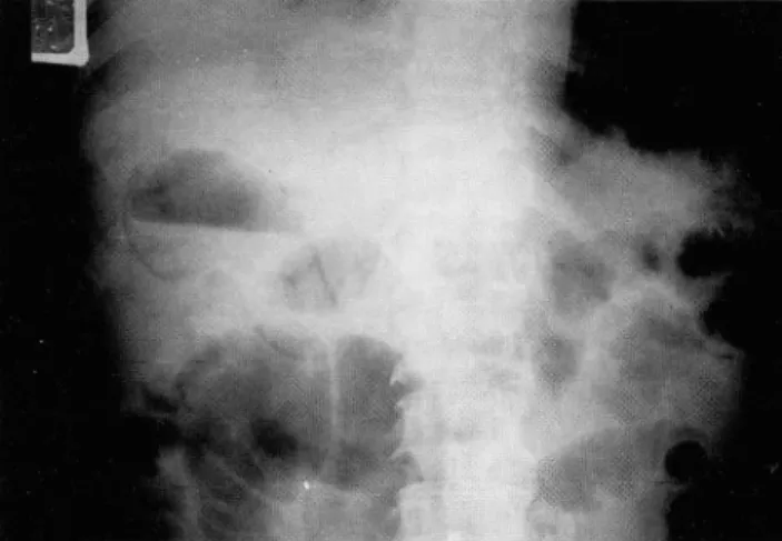 Fig.  1 . Upright  abdominal  radiogram  shows  gas  in  wall  01  the  gallbladder and  a  gas - lluid  level  in  its  lumen 