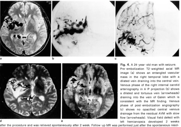 Table  3.  Morphologic Results  of Embolization * 