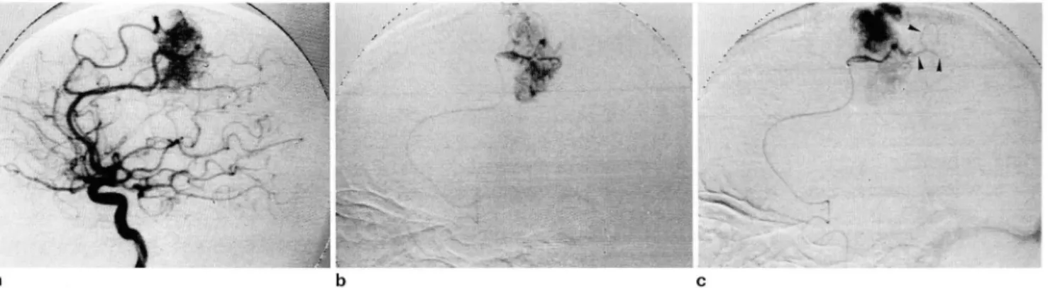 Fig.  5.  A  35 - year - old  man  with  positive  superselective thiopental  test 