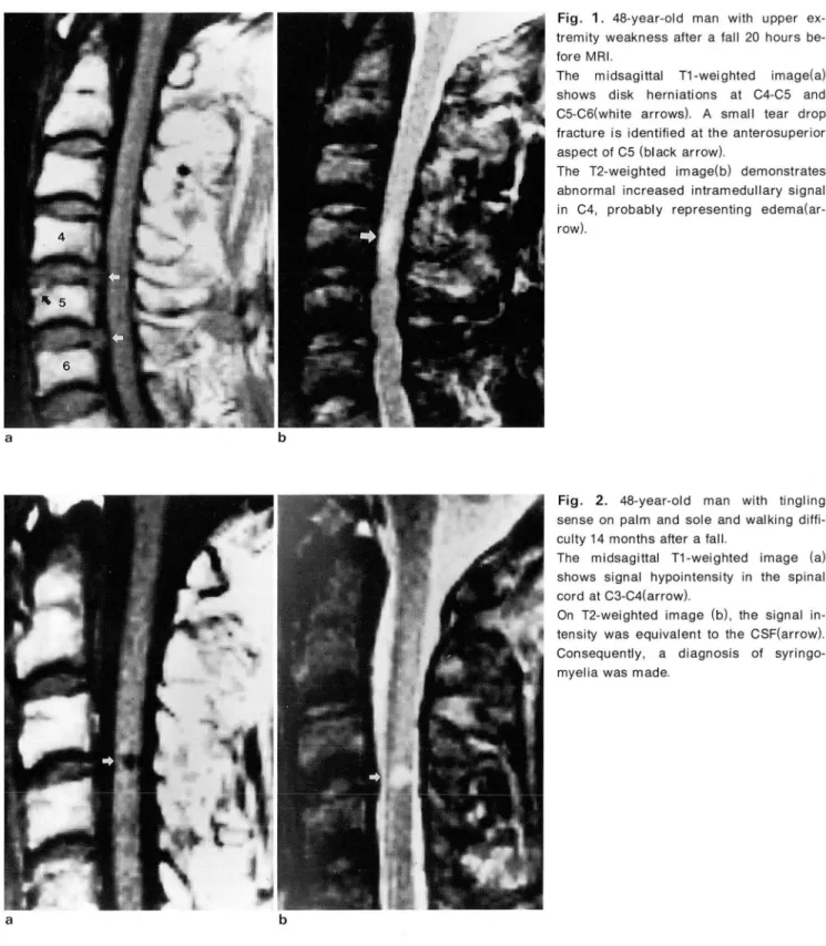 Fig .  1.  48-year-old  man  with  upper  ex- ex-tremity  weakness after  a  fall  20  hours   be-fore MRI 