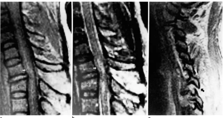 Fig.  3.  41-year-old  woman  with a Brown-Sequard  syndrome after  a  motor vehicle accident  2 days  belore  MR I