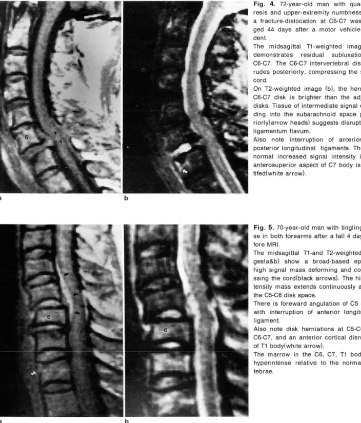 Fig .  4.  72-year-old  man  with  quadri pa- pa-resis  and  upper-extremity  numbness  after  a  Iracture-dislocation  at  C6-C7  was   ima-ged  44  days  after  a  motor  vehicle  acci