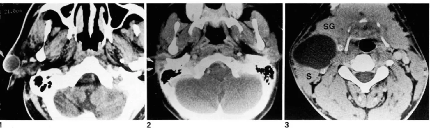 Fig.  2 .  First  branchial  cleft sinus 