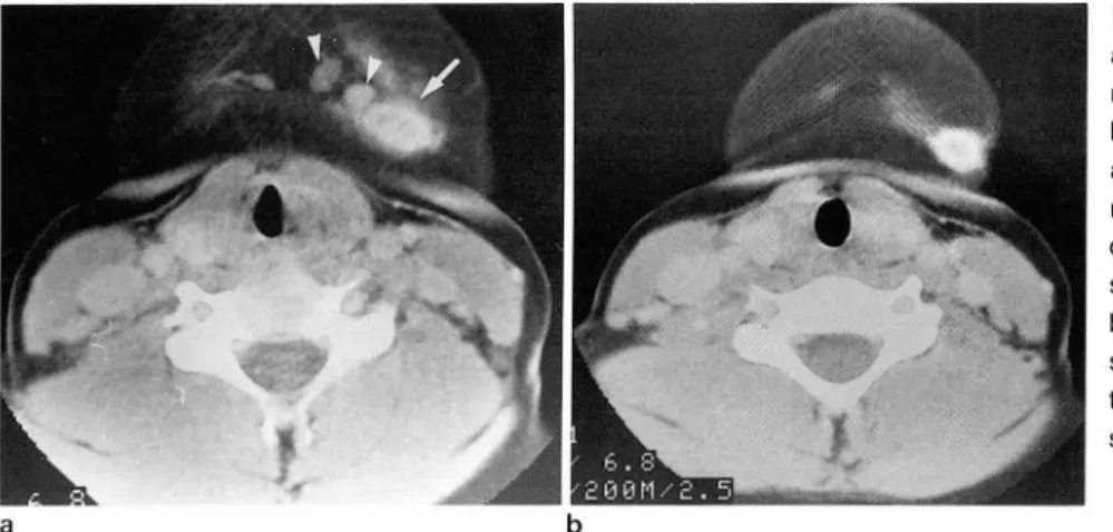 Fig .  6 . Second  branchial  cleft  sinus. 