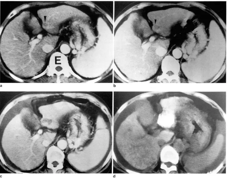 Fig.  3.  A  case  01  early HCC  represents  slow  growth  rate 