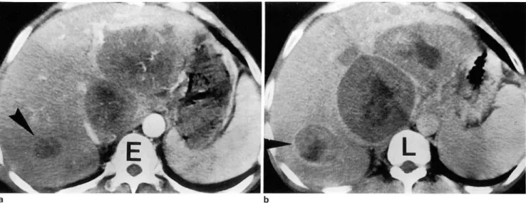 Fig  4.  Rapidly  growing  HCC  at around 3 cm  01  tumor  size 