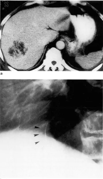 Fig.  1 . Cluster  pattern  of  liver  abscess  in  67  year old  male  a.  CT  scan  shows  the  cluster  pattern  of  m 비 tiple  small  abscesses in  right  lobe of liver 