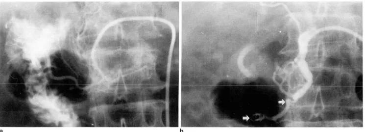 Fig . 2 . 67-year  old  male  patient with  duodenal  leiomyoma  b  심재인  외 · 위장관출혈의  경피경관색전술 괴사의 증거는 없었고， 장티푸스에 의한  궤양형성과 염증 세포의 칭윤을 보였다 (Fig.4)