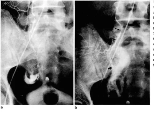 Fig .  4.  43-year  old  male  with  typhoid  le- le-ver 