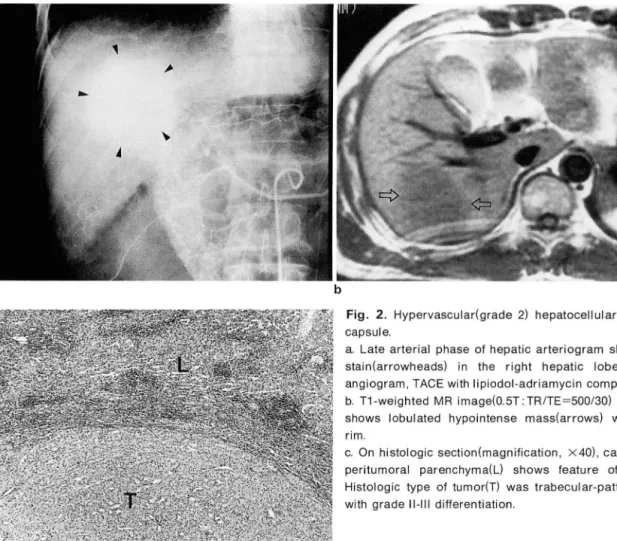 Fig .  2.  Hypervascular(grade  2)  hepatoceliular  carcinoma  without 