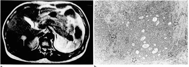 Fig.  5.  Hepatocellular carcinoma  wit h  mixed  trabecu lar-pseudoglandular growth pattern 