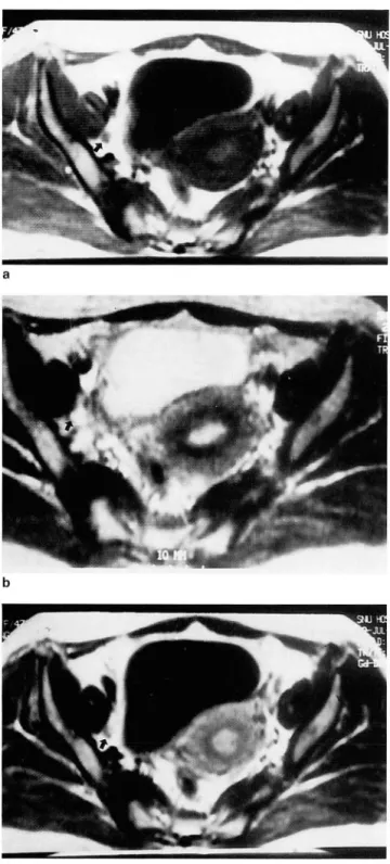 Fig.  1. Stage Ib  uterine cervical  carcinoma 