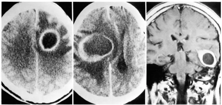 Fig.  1. An  abscess  with  smooth  uniform  enhancing  wall  in  a  51-year- 이 d  man ‘  Axial  enhanced  CT  scan  shows  uniform  thickeness  of  abscess  at  left  frontal  lobe 