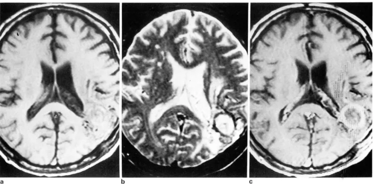 Fig.  4.  MR  intensity  01  an  abscess  in  a  54.year-old  man 