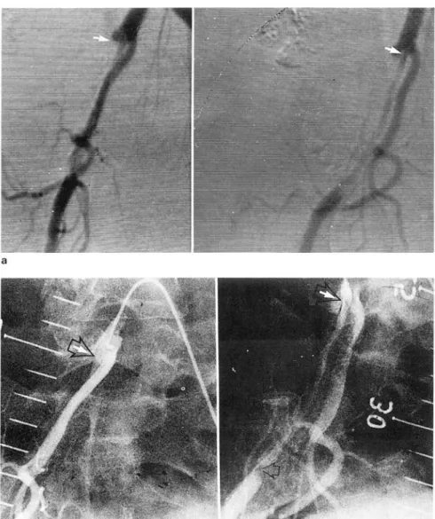 Fig.  1.  A  47-year-old  lemale  was  scree- scree-ned  with  IV-DSA. 