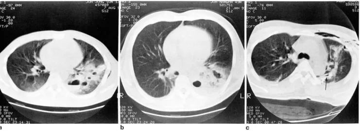 Fig.  2. Types  of  Lung  Lacerations 