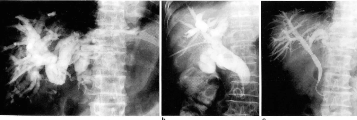 Fig.  2.  Pig-tail  cath eter  lor  external  drainage  was  inserted  into  the  trilurcation  01  biliary  tree  with  complete  obstruction  due  t。