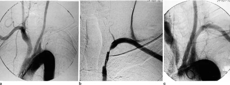 Fig.  3.  a.  Aortic  archgram  shows segmental  narrowing  01  left  subclavian  artery  and  thyrocervical  trunk 