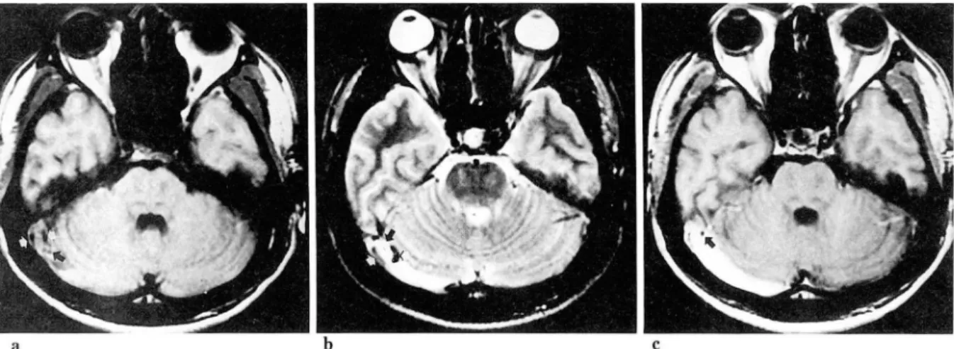 Fig.  1.  a.  SE Tl -weighted  (520/ 14-)  ax ial  image shows  an  area of a  poorly  marginated , isointense  signal  relative  to  gr ay matt er invol vin g  right  transverse  and  sigmoid  sinus (black arrow)