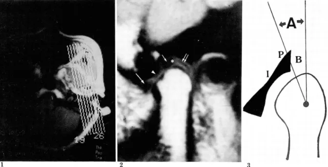Fig.  1.  T1  weighted axiallocalizing image.  Section through  the  condylar head leve l