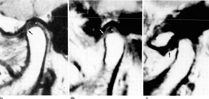 Fig. 5.  MRI  of asymptomatic TM J.  Sagittal Tl-weighted image  in closed-mouth position