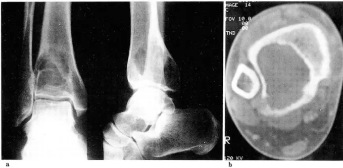 Fig.  1.  Giant cell  tumor with  margin aI  sclerosis  on  the epiphyse aI  portion of the  tumo r