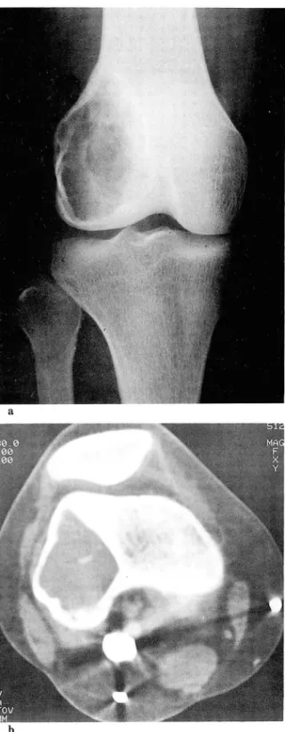 Table  1.  Correlation  of  Grade  Between  the  Plain  Radiography and CT in Terms  of  Mar밍n외  Sclerosis 
