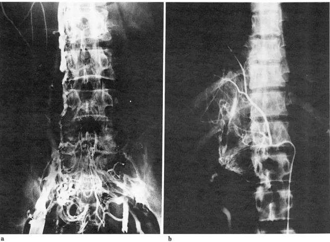 Fig.  3.  Inferior vena cavography  (a). 