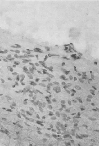 Fig.  4.  Ul trasound  guided  biopsy  of the  IVC  luminal  mass  shows  aggregates  of  plump  spin이e  cells  in  bloody  background