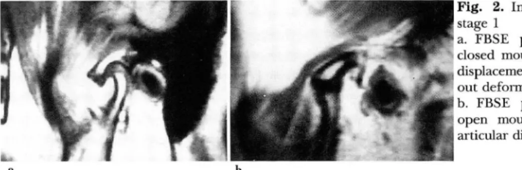 Fig.  2.  Intern a1  derangement  of  stage  1 