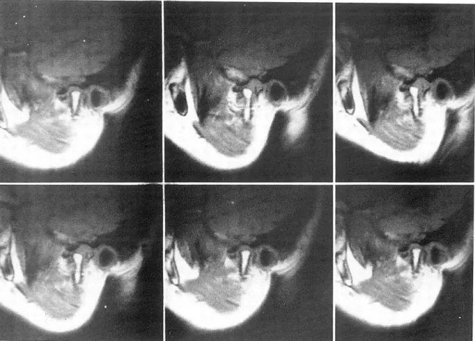 Fig.  5.  c.  Sequential FBSE  parasagittal  Tl  WIs 