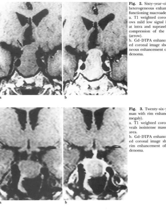 Fig.  2.  Sixty- year-old  man  with  heterogeneous  enhancement   (non-functioning macroadenoma)