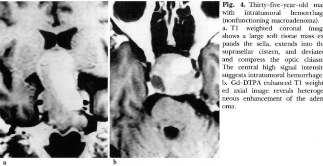 Fig.  4.  Thirty-five-year-old  man  with  intratumor a1  hemorrhage  (nonfunctioning macroadenoma)