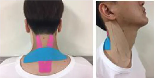 Fig.  1.  Craniovertebral  angle