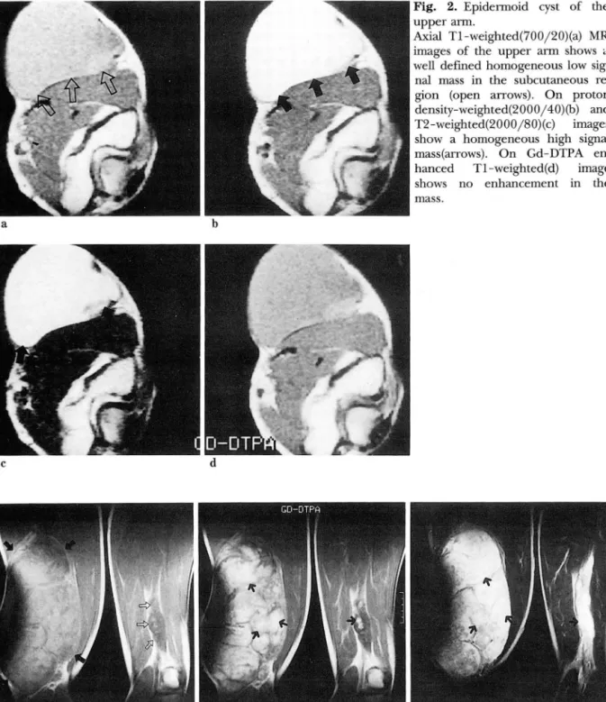 Fig.  3.  Neurofibromatosis  of the both thigh. 