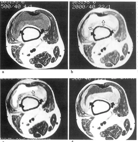 Fig. 5.  Synovial  chondromatosis  of the knee. 