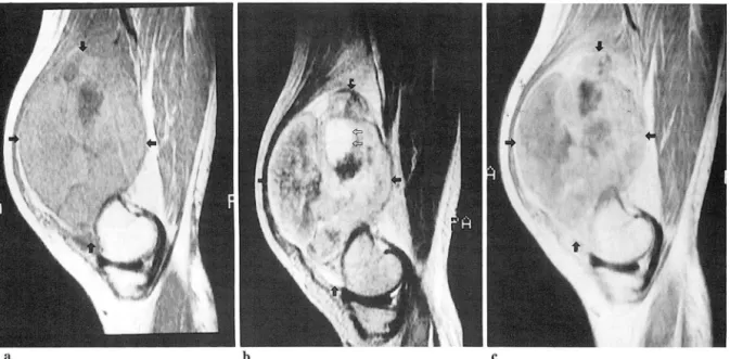Fig.  6.  Pleomorphic  rhabdomyosarcoma of the  thigh . 