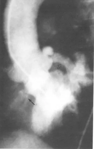 Fig.  1.  LAO  view of left cineventriculogram  reveals an  extremely dilated tortous  left coronary artery(open ar
