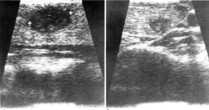 Fig.  1.  a.  The well  defined  hypoechoic  solid  mass  in  the  right  lobe  was  proved to  be  papillary carcinoma