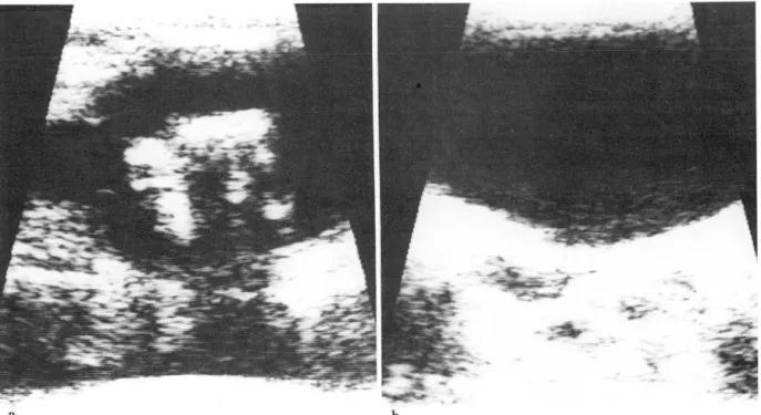 Table  1.  Pathologic  Type  of Mali gnant  Nodules 