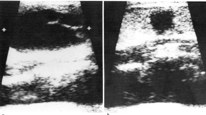 Fig.  3.  a.  The  septated  cystic  mass  in  the  left  lobe  was  proved  to  be  nodul ar hyperp lasia  b 