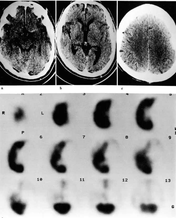 Fig.  1.  66-year-old man with  3-hour-old  infarction.  lniti al precontrast CT scans  show  hyperattenuation  of  left  middle  cerebral  artery (a) ,  loss  of left  insu lar ribbon  (b)  and  mass effect  of left  Sylvian cistern  and left  hemispheric