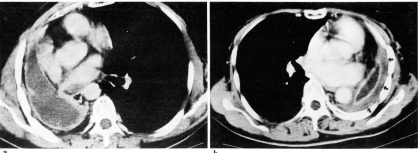 Fig.  3.  47-year-old  m an  with  left  pneum onectom y  sh owing  [at  accumulat ion  in  r et ros terna l  space   (ar-r ows)