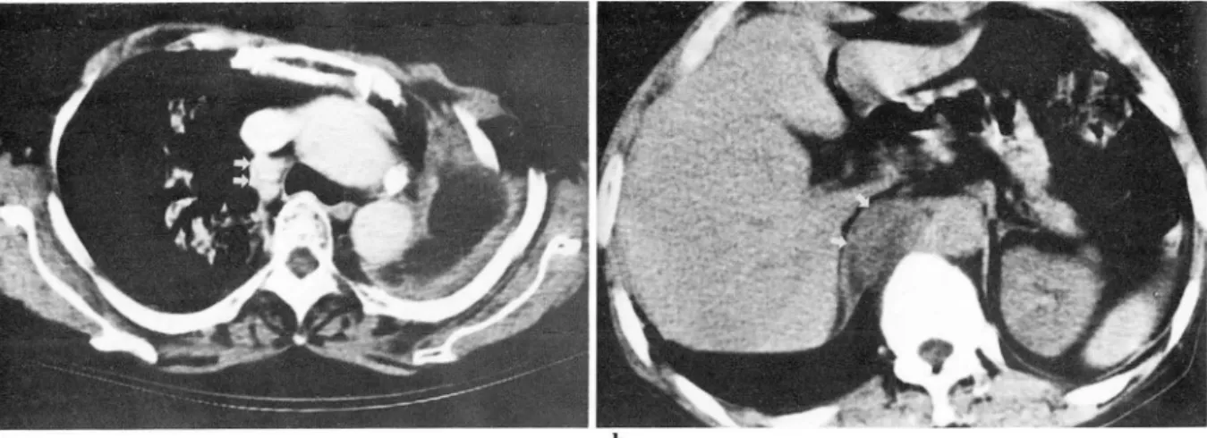 Fig.  4.  CT scan  obtained  10  months  after  pneumonectom y  showing lymph  node  m e tastasis  as  evidence  of  recurrence