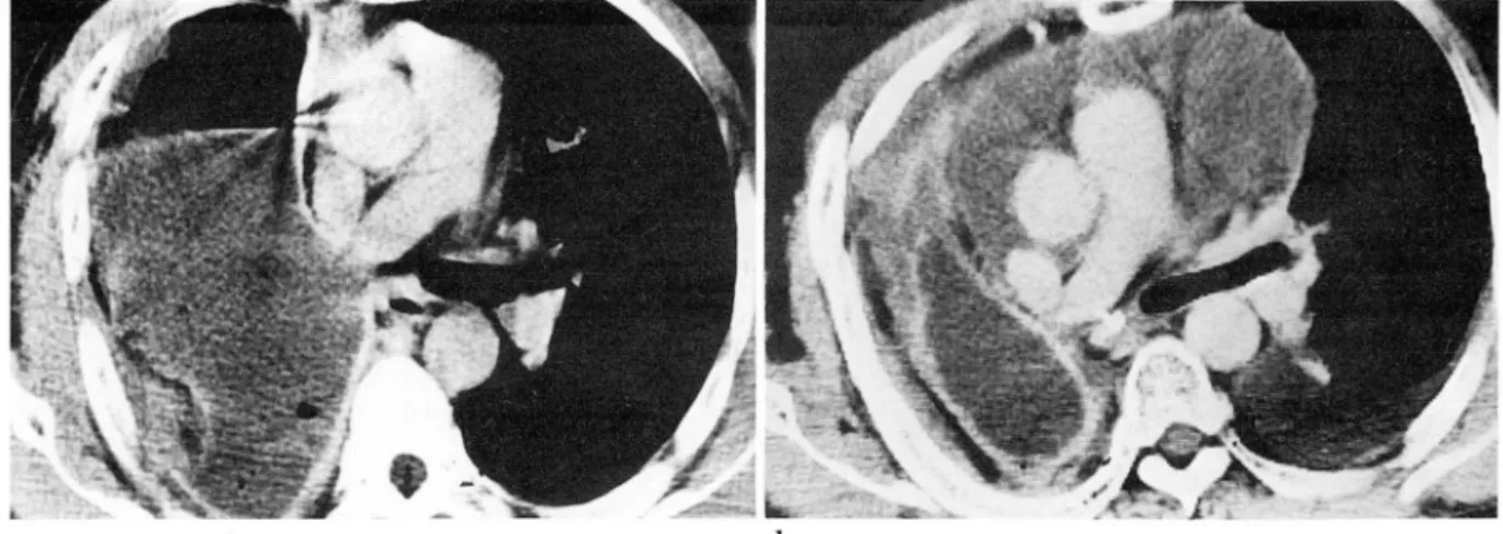 Fig.  6.  44-year-old  man  with  right  pneumonectomy  showing  evidence  of recurred  malignancy  a