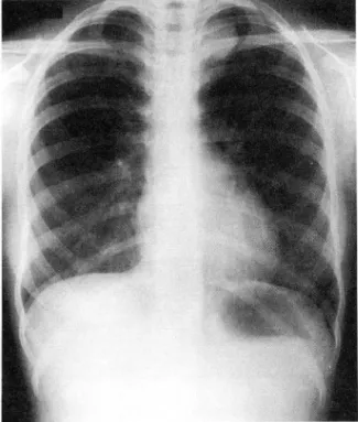 Fig.  l.  Chest  PA 