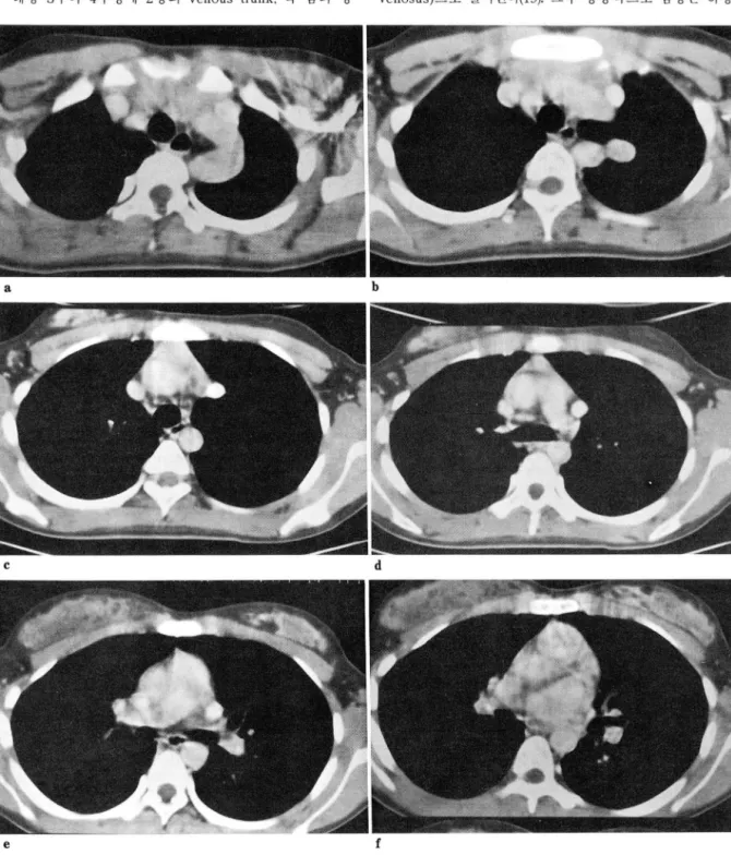 Fig.  2.  Chest CT 